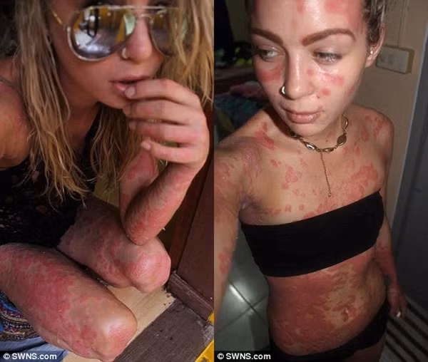 Người đẹp “quái vật” tự tin khoe cơ thể 97% là vẩy nến