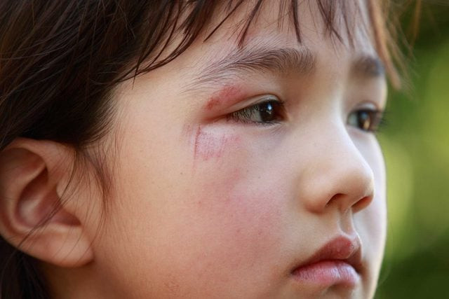 Vết trầy xước hoặc vết bầm tím trên cơ thể là những dấu hiệu đặc trưng của hành vi bắt nạt ở trường. (Ảnh: ITN). Vết trầy xước hoặc vết bầm tím trên cơ thể là những dấu hiệu đặc trưng của hành vi bắt nạt ở trường. (Ảnh: ITN).