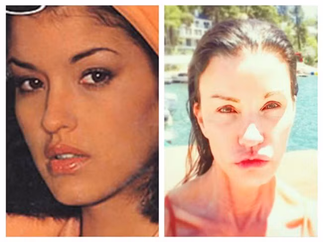 Rùng mình với những cuộc phẫu thuật thẩm mỹ thảm họa của các ngôi sao nổi tiếng, đẹp đâu chẳng thấy chỉ thấy tan nát khuôn mặt - Ảnh 12.