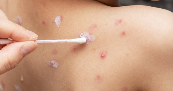 Thủy đậu là một bệnh truyền nhiễm.