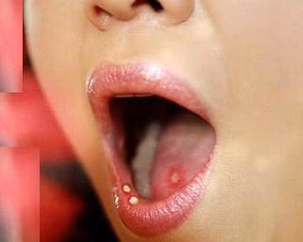 Nhiệt miệng mãi không khỏi, đi khám phải cắt 1/2 lưỡi: cách phân biệt ung thư và nhiệt miệng - 3