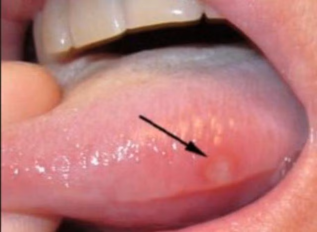 Nhiệt miệng mãi không khỏi, đi khám phải cắt 1/2 lưỡi: cách phân biệt ung thư và nhiệt miệng - 1