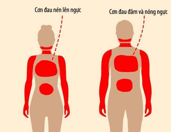 8 dấu hiệu có thể cảnh báo cơn đau tim sớm một tháng 