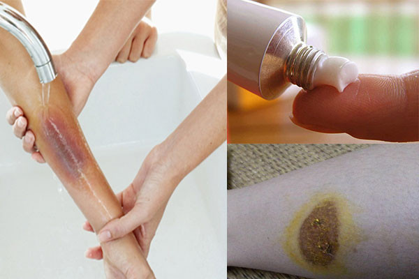 Cách xử lý nhanh khi bị bỏng bô để không có sẹo