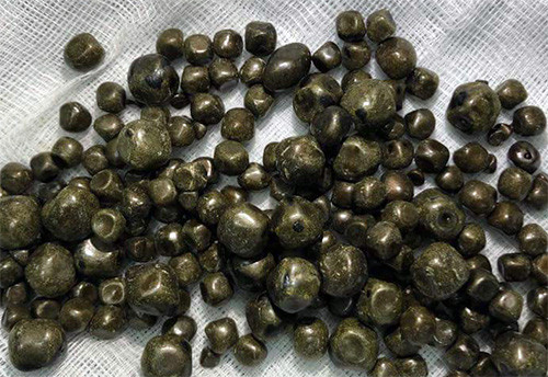 Hàng trăm viên sỏi được lấy ra trong túi mật nữ bệnh nhân 60 tuổi ở Vĩnh Long. Ảnh: Bệnh viện cung cấp