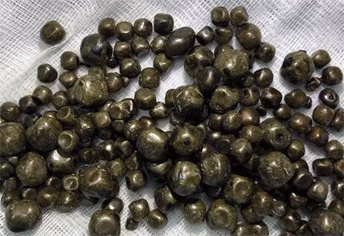 Hàng trăm viên sỏi được lấy ra trong túi mật nữ bệnh nhân 60 tuổi ở Vĩnh Long. Ảnh: Bệnh viện cung cấp