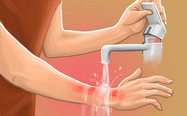 Sơ cứu khi bị bỏng ớt, hạn chế tối đa cảm giác bỏng rát và đau đớn bằng cách nào? - Ảnh 2. Sơ cứu khi bị bỏng ớt, hạn chế tối đa cảm giác bỏng rát và đau đớn bằng cách nào? - Ảnh 2.