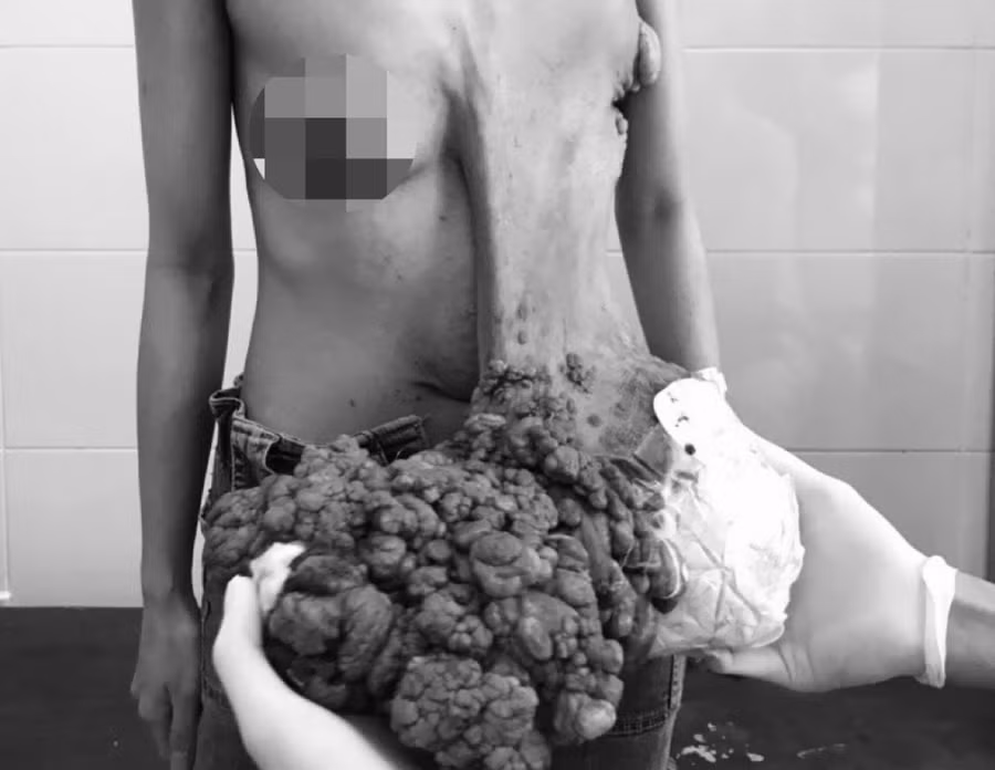 Khối u bệnh nhân trước mổ.