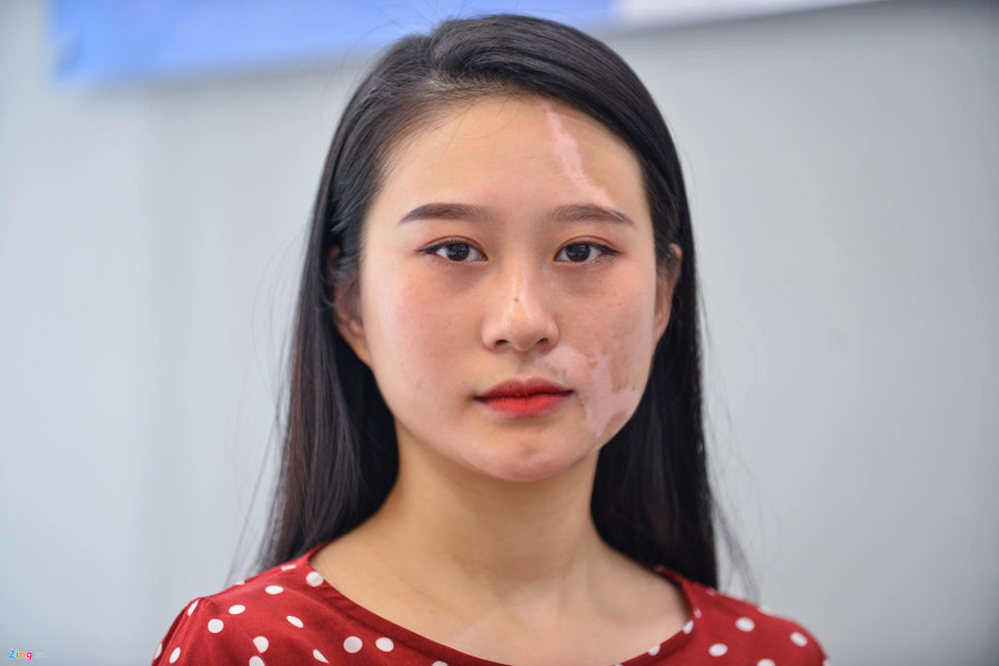 Mơ ước thầm kín của cô gái 20 năm với vết bạch biến trên mặt ảnh 1 Co gai xinh dep bi huy hoai khuon mat vi can benh chua co thuoc chua hinh anh 1