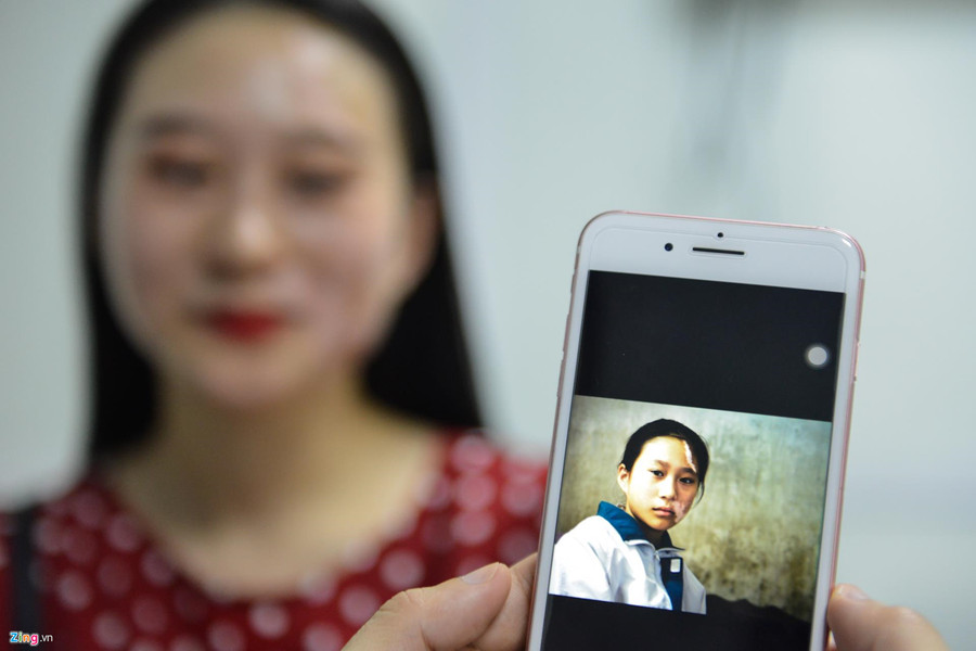 Mơ ước thầm kín của cô gái 20 năm với vết bạch biến trên mặt ảnh 2 Co gai xinh dep bi huy hoai khuon mat vi can benh chua co thuoc chua hinh anh 2