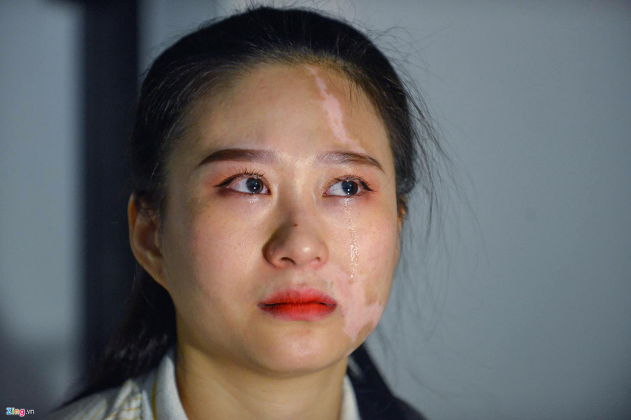 Mơ ước thầm kín của cô gái 20 năm với vết bạch biến trên mặt ảnh 4 Co gai xinh dep bi huy hoai khuon mat vi can benh chua co thuoc chua hinh anh 4