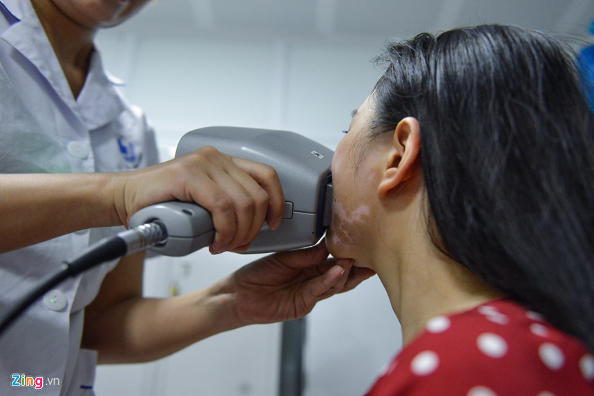 Mơ ước thầm kín của cô gái 20 năm với vết bạch biến trên mặt ảnh 5 Co gai xinh dep bi huy hoai khuon mat vi can benh chua co thuoc chua hinh anh 5