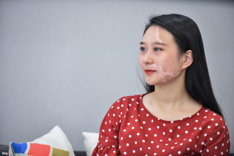 Mơ ước thầm kín của cô gái 20 năm với vết bạch biến trên mặt ảnh 11 Co gai xinh dep bi huy hoai khuon mat vi can benh chua co thuoc chua hinh anh 17