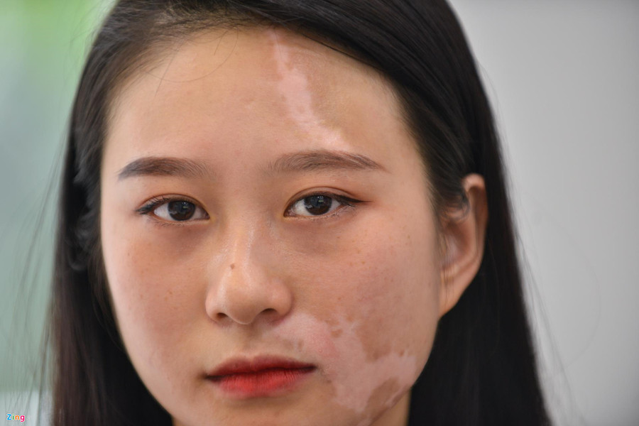 Mơ ước thầm kín của cô gái 20 năm với vết bạch biến trên mặt ảnh 3 Co gai xinh dep bi huy hoai khuon mat vi can benh chua co thuoc chua hinh anh 3