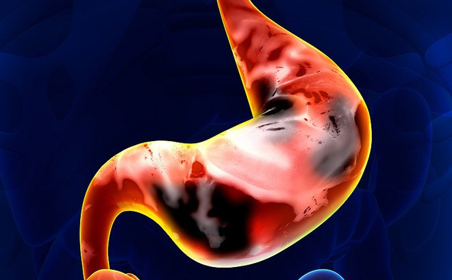 Chàng trai 28 tuổi mắc bệnh ung thư dạ dày, nguyên nhân đến từ thói quen mà giới trẻ mắc phải rất nhiều - Ảnh 4. Chàng trai 28 tuổi mắc bệnh ung thư dạ dày, nguyên nhân đến từ thói quen mà giới trẻ mắc phải rất nhiều - Ảnh 4.