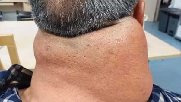 26 năm uống rượu, người đàn ông thành ‘quái vật’ với chiếc cổ kì dị