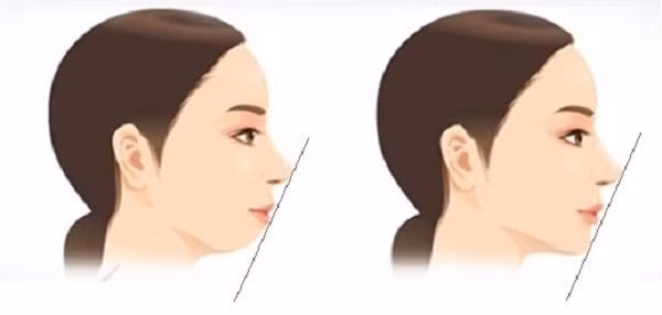 Nữ giới cằm lẹm thường gặp nhiều khó khăn, trắc trở trong cuộc sống.