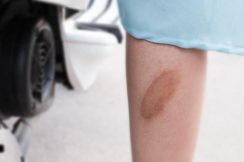 Lên list 5 cách trị sẹo thâm lâu năm ở chân nhanh nhất bạn cần bỏ túi ảnh 1