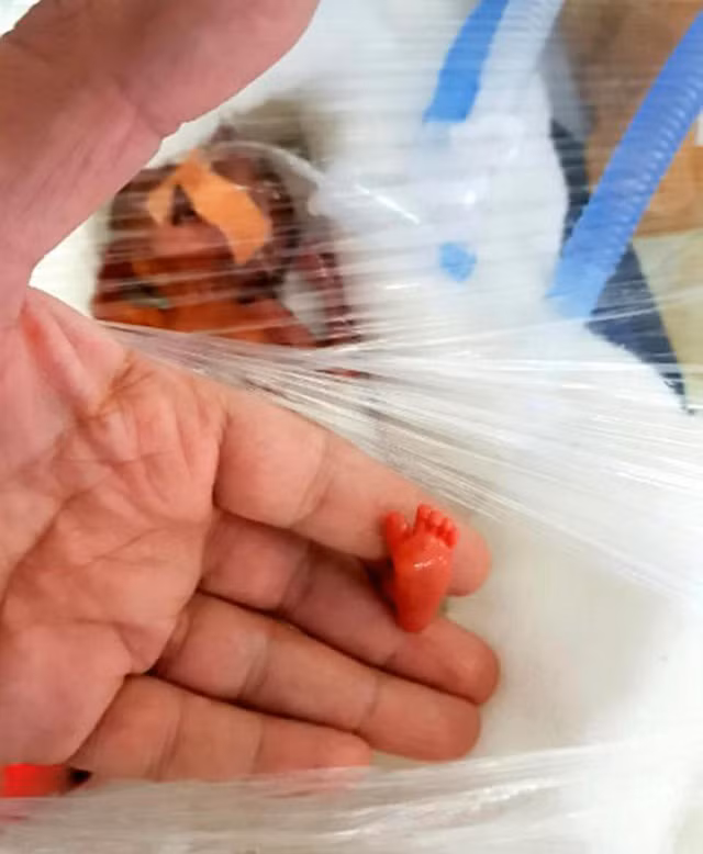 Tim, phổi, não thận của Manushi đều chưa phát triển đầy đủ, da cũng mỏng một cách đáng sợ