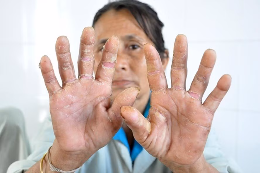 Hội chứng viêm da dày sừng bàn tay, bàn chân tái xuất ở Quảng Ngãi. Ảnh: Lao động.
