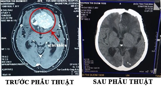 Hình ảnh trước và sau phẫu thuật của cụ bà 81 tuổi. (BVCC)