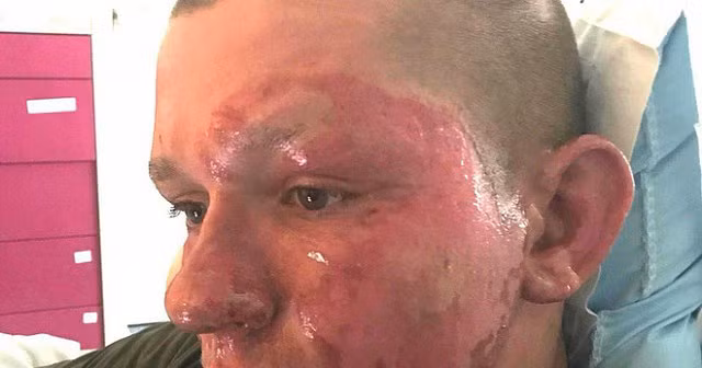 Một trong những loài cây nguy hiểm nhất thế giới đang xâm chiếm nước Mỹ: chạm vào là bỏng như tự thiêu - Hình 2