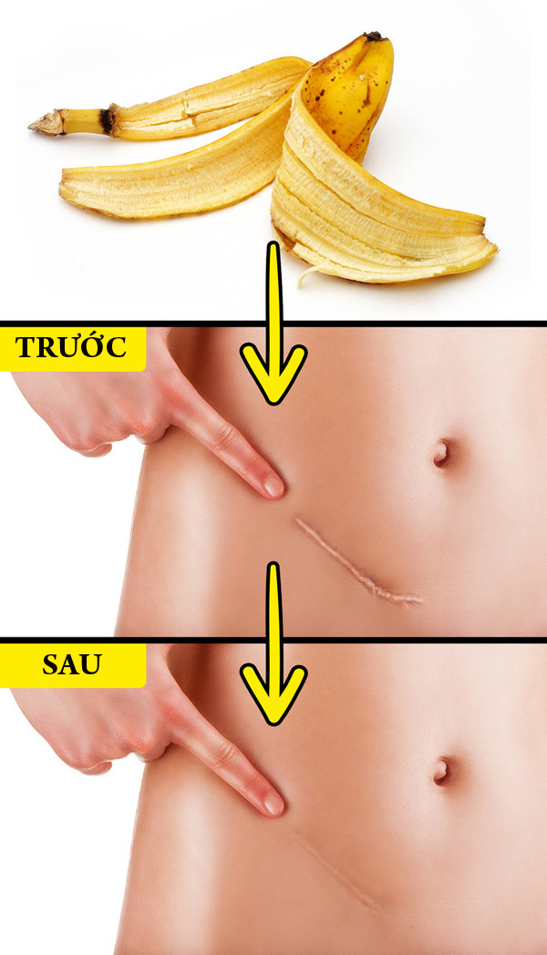 Làm mờ sẹoVỏ chuối chứa nhiều axit béo, có khả năng làm mờ sẹo. Dùng vỏ chuối đắp lên vùng da có sẹo, để qua đêm, sáng hôm sau rửa lại bằng nước sạch. Lặp lại mỗi ngày để có thấy được hiệu quả.