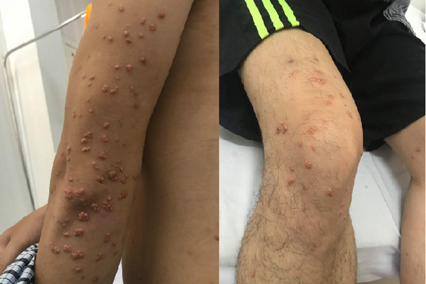 Nam thanh niên tự nặn mụn, hoá ra nốt sùi mọc tua tủa khắp người Nam thanh niên tự nặn mụn, hoá ra nốt sùi mọc tua tủa khắp người