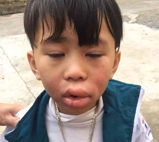 Một bé trai nghi bị ngộ độc sau khi ăn kẹo ở cổng trường