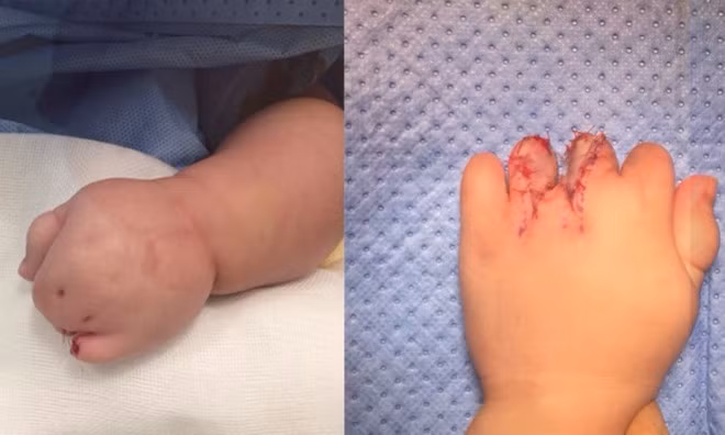 Bé gái Campuchia được bác sĩ Việt mổ tách tay, chân dính ngón