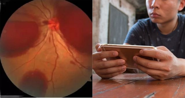 Nam bệnh nhân không ngờ rằng dùng điện thoại trong bóng tối lại có thể khiến mình bị mù.