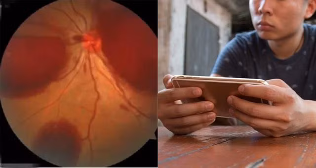 Nam bệnh nhân không ngờ rằng dùng điện thoại trong bóng tối lại có thể khiến mình bị mù.