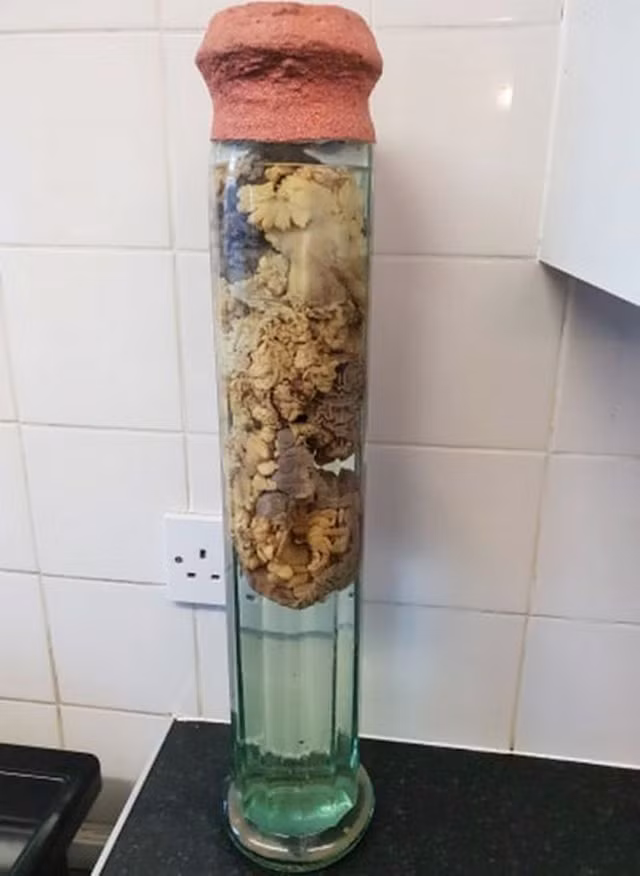 Chồng qua đời vì nhiễm trùng, vợ giữ lại ruột để làm kỷ niệm - 2