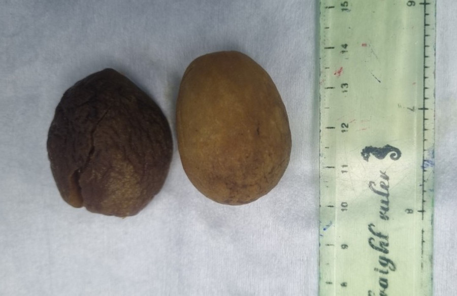 Hai quả chà là được lấy ra sau phẫu thuật.