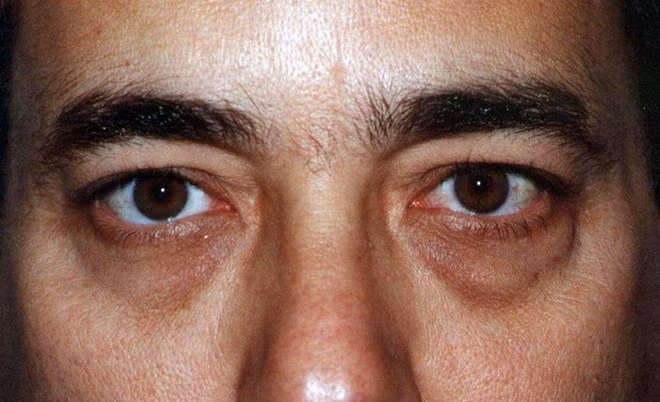 Khi 4 bộ phận cơ thể chuyển màu đen: Hãy thận trọng với dấu hiệu bệnh gan đang phát triển-2