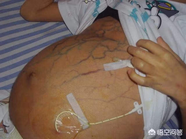 Khi 4 bộ phận cơ thể chuyển màu đen: Hãy thận trọng với dấu hiệu bệnh gan đang phát triển-3