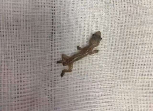 Bác sĩ bối rối phát hiện con vật đỏ hỏn, ngọ nguậy trong tai bệnh nhân