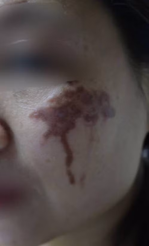 Hai má loang lổ, thâm tím vì chữa nám bằng axit tại spa ảnh 1