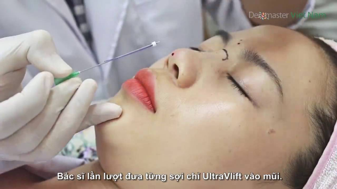 Dù là phương pháp ít xâm lấn, việc nâng mũi bằng chỉ vẫn cần được thực hiện bởi bác sĩ có tay nghề cao. Bác sĩ tư vấn cách chọn chỉ sinh học nâng mũi không biến chứgChọn chỉ sinh học nâng mũi an toàn, không biến chứng theo tư vấn của bác sic - 1