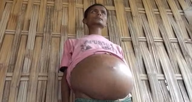 Anh bắt đầu cảm thấy đau bụng, khó thở từ 5 năm trước