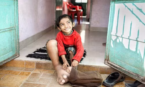 Verdant không hề cảm thấy đau hay khó chịu về bàn chân của mình