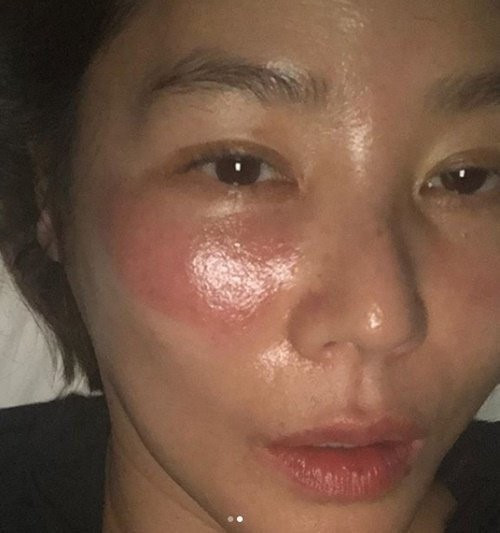 Mỹ nữ xứ Hàn bị bỏng rát mặt chỉ vì một lần đắp mặt nạ qua đêm: Lời cảnh báo thói quen làm đẹp chị em cần chấn chỉnh! - Ảnh 1. Mỹ nữ xứ Hàn bị bỏng rát mặt chỉ vì một lần đắp mặt nạ qua đêm: Lời cảnh báo thói quen làm đẹp chị em cần chấn chỉnh! - Ảnh 1.