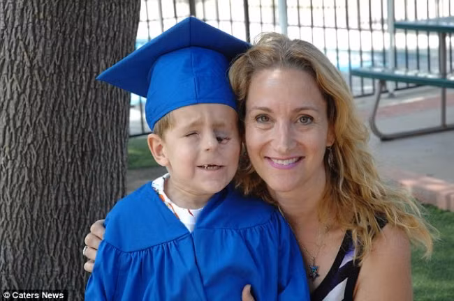 Hành động đáng kinh ngạc của cậu bé 5 tuổi hở hàm ếch bị xa lánh và kỳ thị