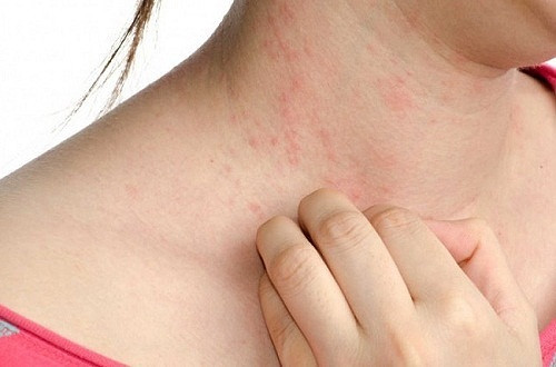 Những người đại kỵ với trai, hến, đừng ăn kẻo