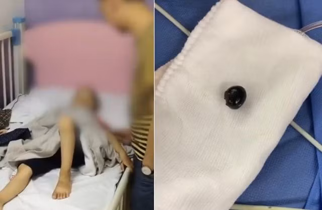 Con thường xuyên nôn ói, bố mẹ tá hỏa phát hiện thứ kỳ lạ trong người