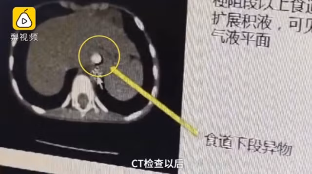 con thuong xuyen non, tam than khong on dinh, bo me ta hoa phat hien thu ky la trong nguoi - 1