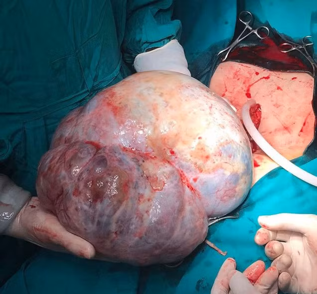 Khối u khổng lồ nặng hơn 6kg trong ổ bụng người phụ nữ