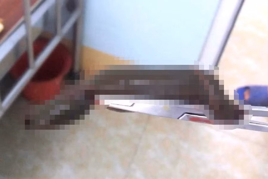 Con đĩa được gắp ra trong dương vật người đàn ông 71 tuổi. Ảnh. Đức Anh.