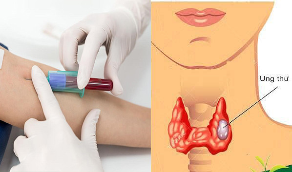 Đề phòng ung thư, phụ nữ từ 20-40 tuổi nhất định phải làm 6 xét nghiệm cực quan trọng này