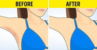 Sử dụng Vaseline để tránh trầy da trong những ngày hè.